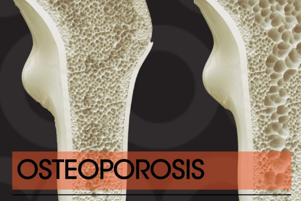 Osteoporosis Risks if you don’t take HRT